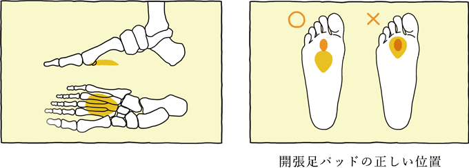 左：開張足　右：健康な足　開張足パッドの正しい位置