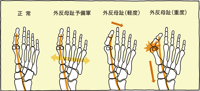 外反母趾とは?正しい知識と原因・対策