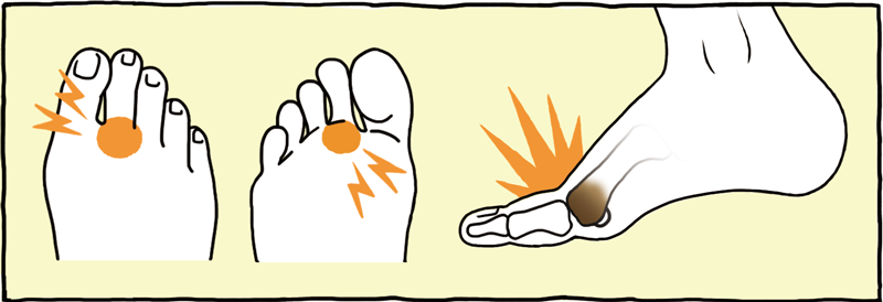 痛い 足 の 中指 指