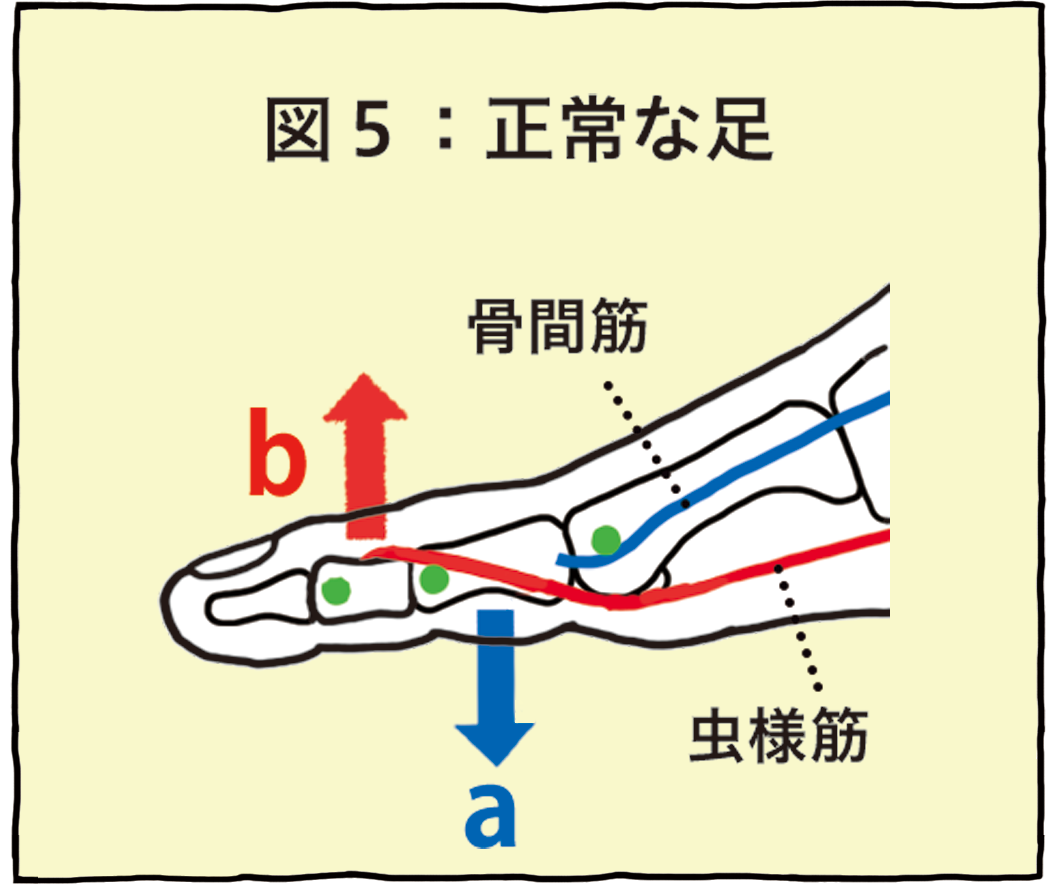図5：正常な足 骨間筋・虫様筋